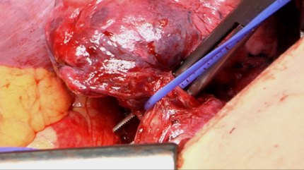 Video still (lobectomy) from the Panasonic AG-HVX200 (DVCPro50)