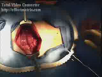 Video still from SurgeonCam (streamor.com)