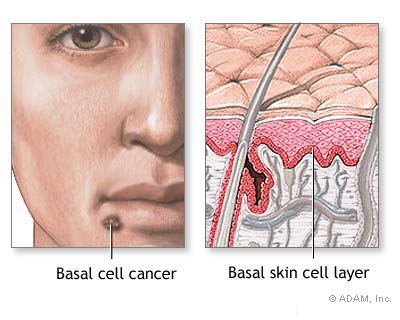 Basal cell cancer
