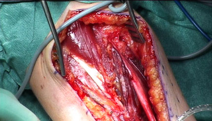 Normal operative field