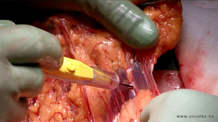 Monopolar diathermy of the omentum