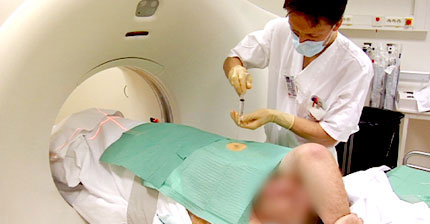 CT-guided lung FNAC biopsy