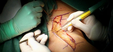 Left inguinal lymph node dissection.
