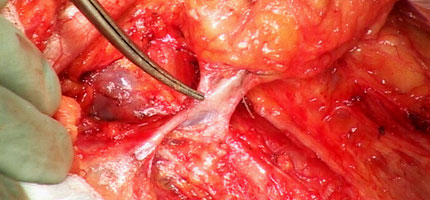 The great saphenous vein passing through the nodal packet.