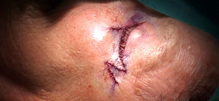 A skin excision repaired with the use of z-plasty