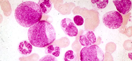 Chronic lymphatic leukemia