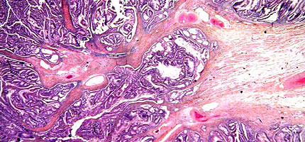 Colorectal adenocarcinoma