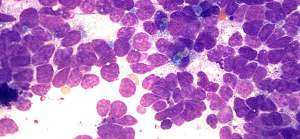 Small cell lung carcinoma