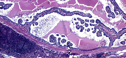 Papillary carcinoma of the thyroid.