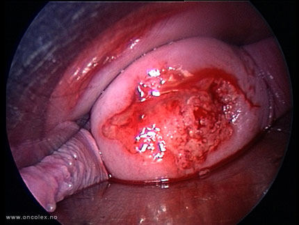 Video still from a vaginal trachelectomy