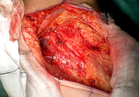 The left groin after an inguinal lymph node dissection.