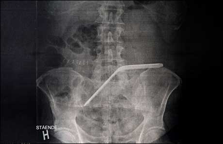 x-ray_sponge Terje Mortensen, VG