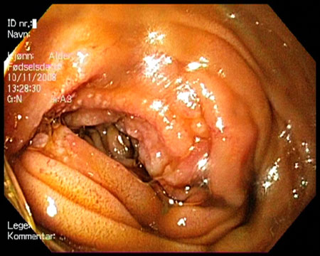 duodenal_lymphoma Duodenal lymphoma as viewed through the gastroscope.