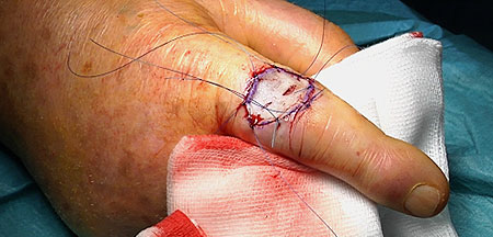 Full-thickness skin graft
