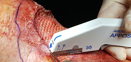 Split-thickness skin graft on the back of the knee.